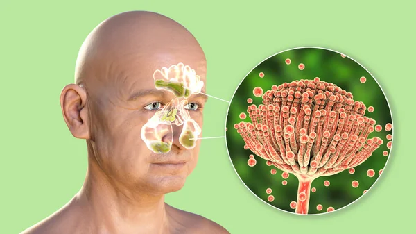 Aspergillus Fungi Cause Sinusitis Illustration Showing Inflammation Frontal Maxillary Ethmoid — Stock Photo, Image