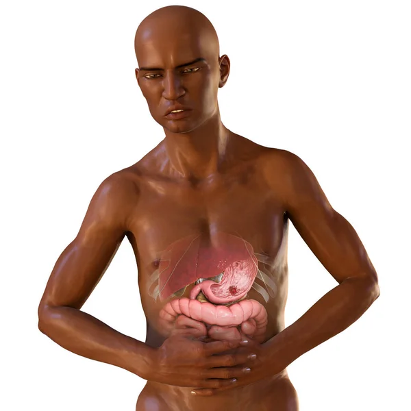 胃の痛み 胃潰瘍 概念的な3Dイラスト 胃の痛みに苦しんでいる暗い皮膚の男は 胃の中の臓器や潰瘍を強調 — ストック写真