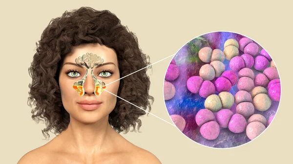 Streptococcus Pneumoniae Bacteria Cause Sinusitis Illustration Showing Inflammation Maxillary Sinuses — Stock Photo, Image