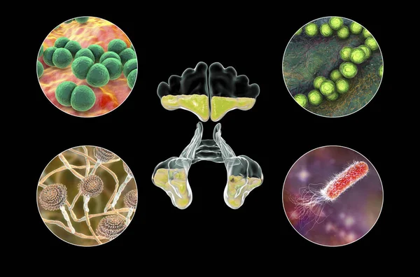 Ανατομία Ρινοζωματίτιδας Και Μικροοργανισμών Που Προκαλούν Βακτήρια Ιγμορίτιδας Streptococcus Pneumoniae — Φωτογραφία Αρχείου