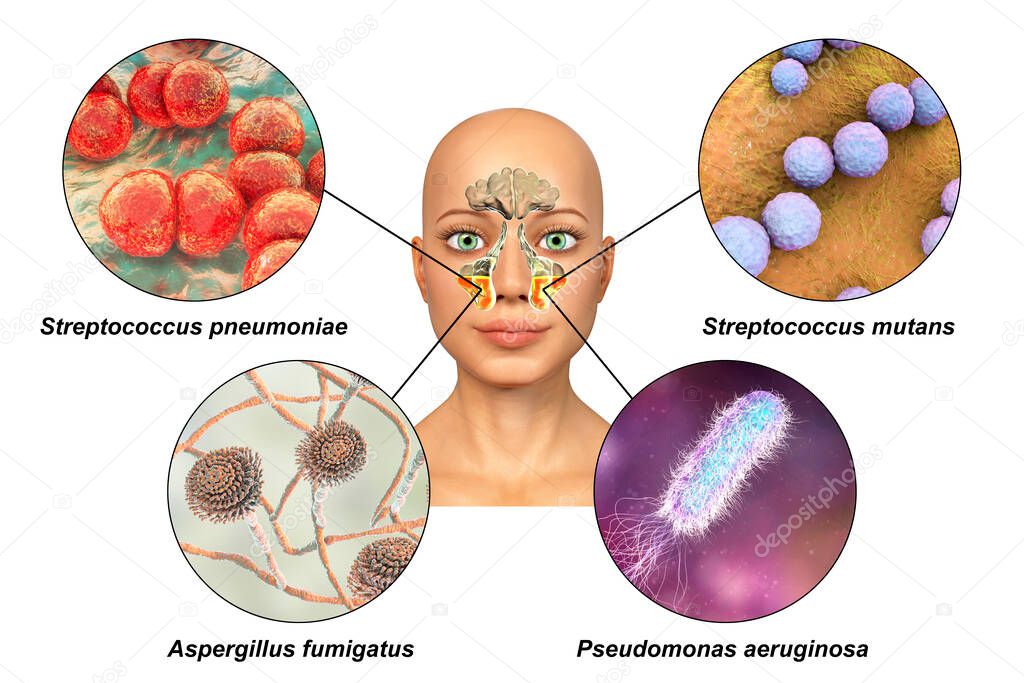 Anatomy of rhinosinusitis and microorganisms that cause sinusitis Streptococcus pneumoniae, Streptococcus mutans, Aspergillus fumigatus, and Pseudomonas aeruginosa, labelled 3D illustration