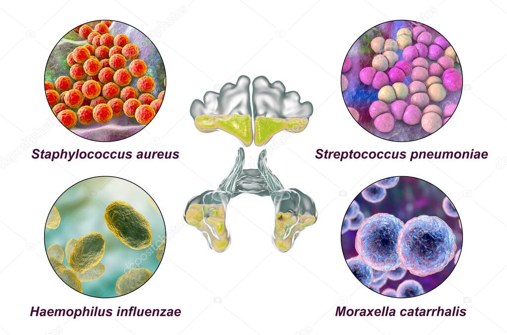 Anatomy of rhinosinusitis and bacteria that cause sinusitis Staphylococcus aureus, Streptococcus pneumoniae, Haemophilus influenzae, and Moraxella catarrhalis, labelled 3D illustration