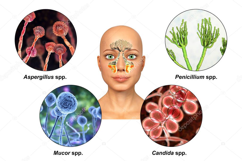 Fungi as a cause of sinusitis. 3D illustration showing inflammation of maxillary sinuses and fungi Aspergillus, Penicillium, Mucor and Candida. Chronic fungal sinusitis. Labelled image