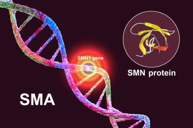 Spinal kas atrofisi, SMA, SMN1 genindeki mutasyon nedeniyle motor nöron kaybı nedeniyle ilerleyen kas atıkları ile genetik nöromusküler bozukluk, kavramsal 3D çizim