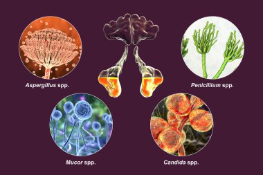 Sinüzitin sebebi mantarlar. Etiketlenmiş 3D illüstrasyon maksiller sinüsler ve mantar Aspergillus, Penisilyum, Mucor ve Candida iltihaplanmalarını gösteriyor. Kronik mantar sinüziti