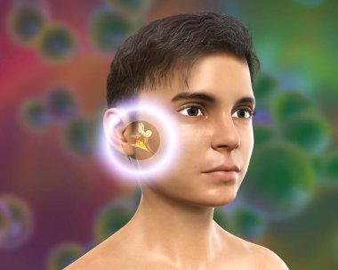 Otitis medyası, orta kulağın bir grup iltihaplı hastalığı, üç boyutlu illüstrasyonda orta ve iç hava ve iltihap birikimlerinin vurgulandığı bir çocuk görülüyor.