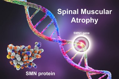 Spinal kas atrofisi, SMA, SMN1 genindeki mutasyon nedeniyle motor nöron kaybı nedeniyle ilerleyen kas atıkları ile genetik nöromusküler bozukluk, kavramsal 3D çizim