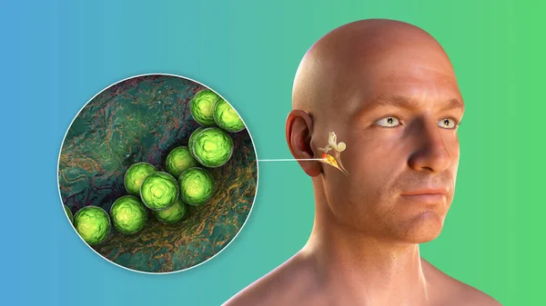 Streptococcus Bakterie Jako Příčina Zánětu Středního Ucha Ilustrace Ukazující Purulentní — Stock fotografie