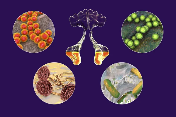Anatomía Rinosinusitis Bacterias Que Causan Sinusitis Staphylococcus Aureus Streptococcus Pyogenes —  Fotos de Stock