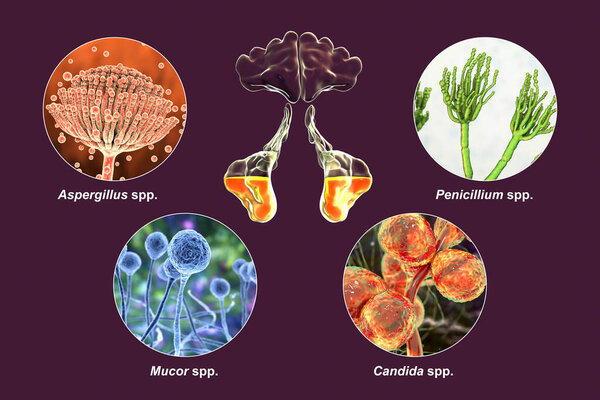 Fungi as a cause of sinusitis. Labelled 3D illustration showing inflammation of maxillary sinuses and fungi Aspergillus, Penicillium, Mucor and Candida. Chronic fungal sinusitis