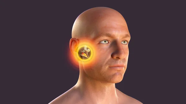 Otitis Media Group Inflammatory Diseases Middle Ear Illustration Showing Male — Stock Photo, Image