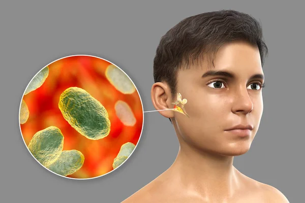 Haemophilus Influenzae Bakterie Som Årsag Til Otitis Media Illustration Der - Stock-foto