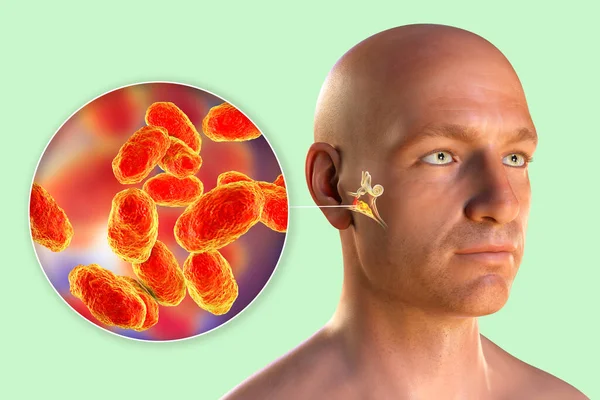 流感嗜血杆菌是引起中耳炎的原因之一 三维图显示男性中耳脓性炎症及血友病菌近视 — 图库照片