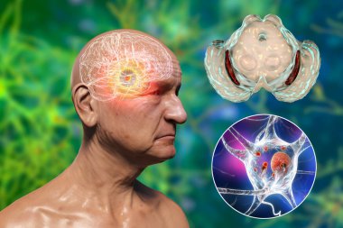 Parkinson hastası yaşlı bir adam ve orta beynin siyah maddesini işaretlemiş. 3 boyutlu illüstrasyon gösteriyor ki dopaminerjik nöronlarında azalan azalma ve Lewy cisimlerinin birikimi