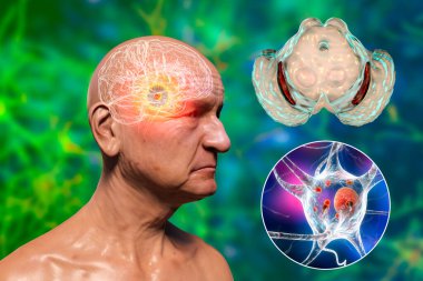 An old man with Parkinson's disease and highlighted black substance of the midbrain. 3D illustration shows decrease of substantia volume and accumulation of Lewy bodies in its dopaminergic neurons clipart