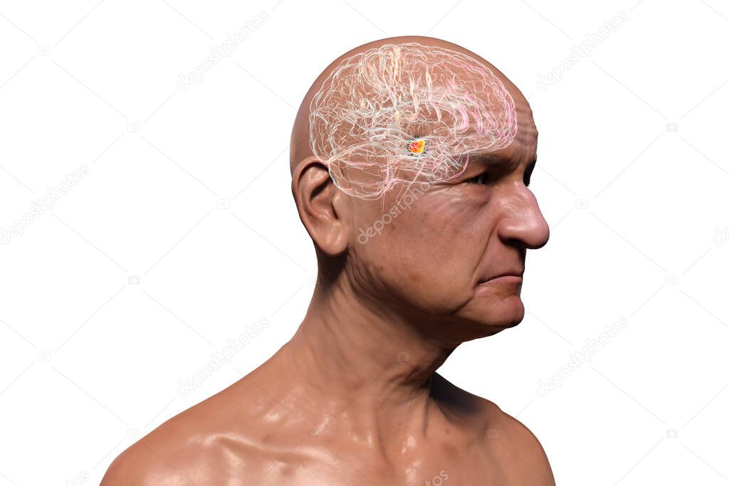 An old man with highlighted brain and Black substance of the midbrain, 3D illustration. Black substance regulates movement, its degeneration is a key step in development of Parkinson's disease