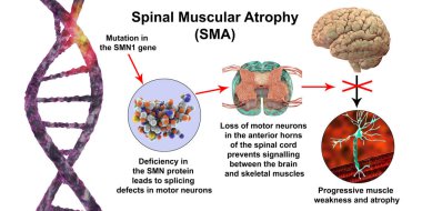 Spinal kas atrofisi, SMA, SMN1 genindeki mutasyon, SMN proteinindeki eksiklik ve motor nöron kaybı, 3D illüstrasyon yüzünden ilerleyen kas israfı ile genetik nöromüsküler bozukluk.