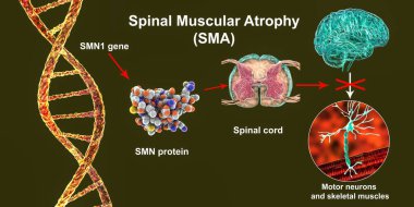 Spinal kas atrofisi, SMA, SMN1 genindeki mutasyon, SMN proteinindeki eksiklik ve motor nöron kaybı, 3D illüstrasyon yüzünden ilerleyen kas israfı ile genetik nöromüsküler bozukluk.