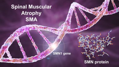 Spinal kas atrofisi, SMA, SMN1 genindeki mutasyon nedeniyle motor nöron kaybı nedeniyle ilerleyen kas atıkları ile genetik nöromusküler bozukluk, kavramsal 3D çizim