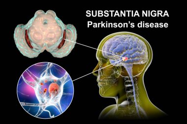 Black substance of the midbrain in Parkinson's disease, 3D illustration showing decrease of its volume and accumulation of Lewy bodies in dopaminergic neurons of the black substance clipart