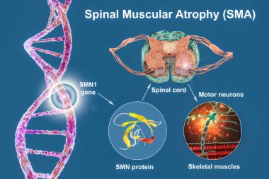 Spinal kas atrofisi, SMA, SMN1 genindeki mutasyon, SMN proteinindeki eksiklik ve motor nöron kaybı, 3D illüstrasyon yüzünden ilerleyen kas israfı ile genetik nöromüsküler bozukluk.