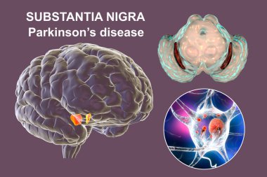 Parkinson hastalığında orta beynin siyah maddesi, 3 boyutlu illüstrasyon Lewy cisimlerinin siyah maddenin dopaminerjik nöronlarında hacminin ve birikiminin azaldığını gösteriyor.