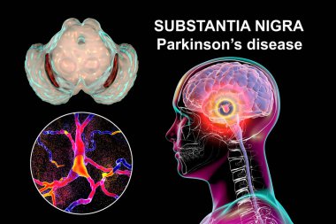Parkinson hastalığındaki orta beynin siyah maddesi. Siyah maddenin pars compacta 'sındaki dopaminerjik nöronların hacminde ve dejenerasyonunda 3 boyutlu çizimler gösteriyor.