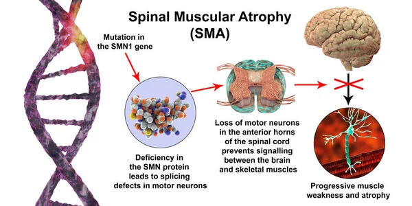 Spinal Muskelatrofi Sma Genetisk Neuromuskulär Sjukdom Med Progressiv Muskelförtvining Grund — Stockfoto