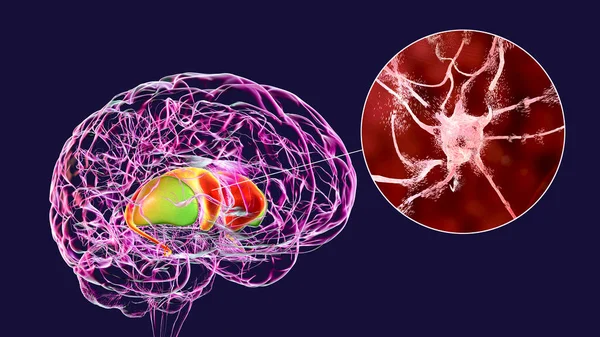 在人类大脑中突出的背侧纹状体和亨廷顿病中看到的背侧纹状体退化神经元的特写 3D说明 — 图库照片