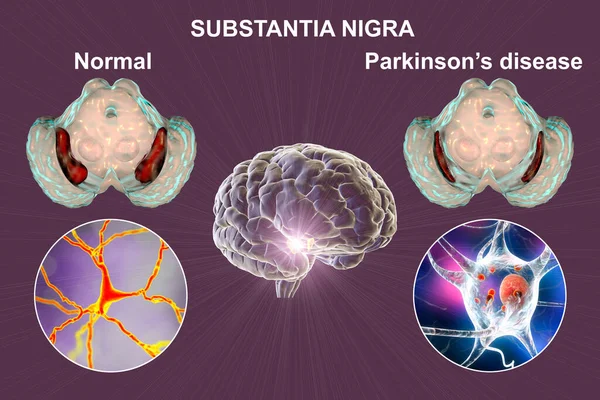 Substância Negra Mesencéfalo Seus Neurônios Dopaminérgicos Estado Normal Doença Parkinson — Fotografia de Stock