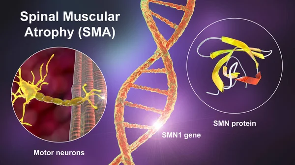 Atrofia Muscular Espinal Sma Trastorno Neuromuscular Genético Con Desgaste Muscular — Foto de Stock