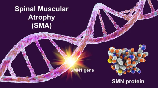 Sma Smn1 유전자의 돌연변이로 뉴런의 손실로 진행적 소모를 동반하는 유전적 — 스톡 사진
