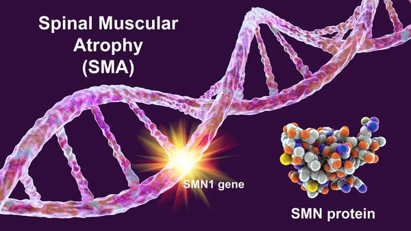 Atrophie Musculaire Colonne Vertébrale Sma Trouble Neuromusculaire Génétique Avec Gaspillage — Photo