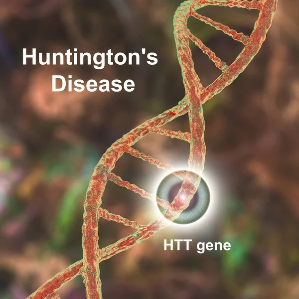 Doença Huntington Também Conhecida Como Coreia Huntington Uma Doença Neurodegenerativa — Fotografia de Stock