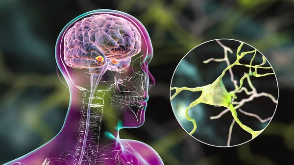 Amygdala in the brain, and closeup view of amygdala neurons, 3D illustration. Two almond-shaped clusters of nuclei within temporal lobes, part of the limbic system, play role in memory and emotions