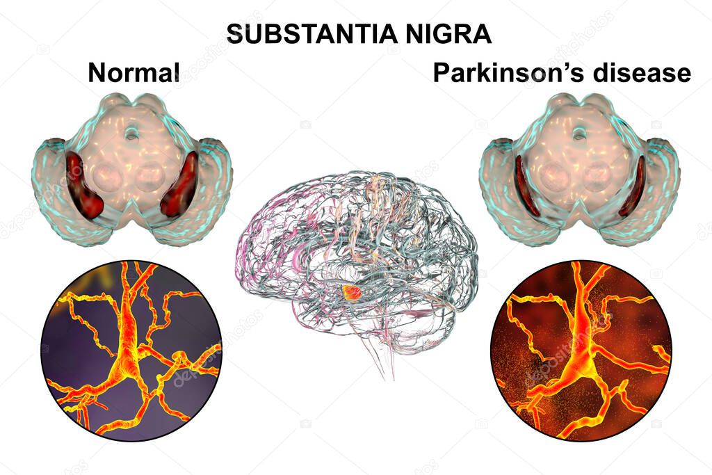 Black substance of the midbrain and its dopaminergic neurons in normal state and in Parkinson's disease, 3D illustration showing decrease of substantia volume and degeneration of dopaminergic neurons
