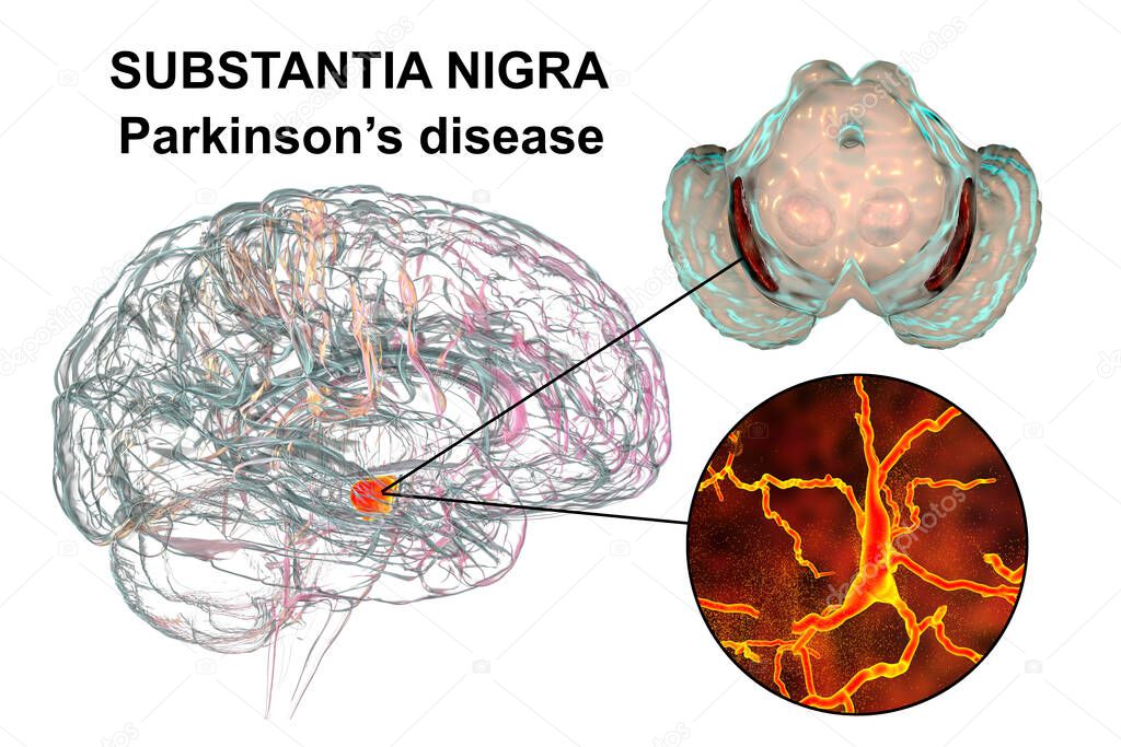 Black substance of the midbrain in Parkinson's disease, 3D illustration showing decrease of its volume and degeneration of dopaminergic neurons in the pars compacta of the Black substance