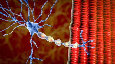 Nöronun tanıtılması, demiyelinizan hastalıklarda görülen nöron miyelin kılıfının hasarı, üç boyutlu illüstrasyon. Çoklu skleroz ve miyelinoklastik ve lökodirofik hastalıklar.