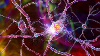 Dorsal striatum nöronlarının tahrip edilmesi, kavramsal 3 boyutlu illüstrasyon. Sırt striatumu beyin bazal gangliyasındaki bir çekirdektir. Nöronları Huntingon hastalığı ve diğer korealarda hasar görmüştür.