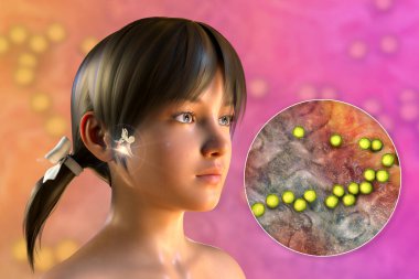 Otitis medyasının bir nedeni olarak Streptococcus bakterisi. Bir kızda orta kulakta iltihap ve streptokok bakterisinin yakın plan görüntüsünü gösteren 3 boyutlu illüstrasyon.