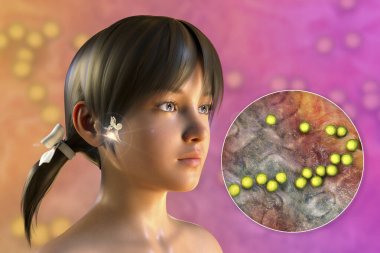 Streptococcus bacterium as a cause of otitis media. 3D illustration showing purulent inflammation of the middle ear in a girl and close-up view of streptococci bacteria clipart