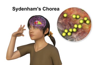 Sydenham 'ın koreası, Streptococcus enfeksiyonundan kaynaklanan otoimmün bir hastalık, beyin bazal gangliyasına zarar veren anti-nöronal antikorların oluşumu istemsiz hareketlere, 3 boyutlu illüstrasyonlara,