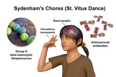 Sydenham 'ın koreası, Streptococcus enfeksiyonundan kaynaklanan otoimmün bir hastalık, beyin bazal gangliyasına zarar veren anti-nöronal antikorların oluşumu istemsiz hareketlere, 3 boyutlu illüstrasyonlara,