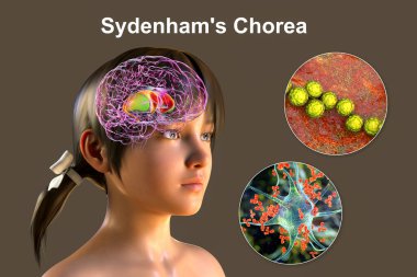 Sydenham 'ın koreası, Streptococcus enfeksiyonundan kaynaklanan otoimmün bir hastalık, beyin bazal gangliyasına zarar veren anti-nöronal antikorların oluşumu istemsiz hareketlere, 3 boyutlu illüstrasyonlara,