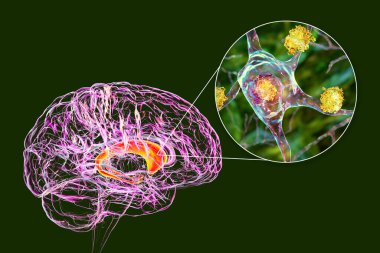 Huntington hastalığında beynin karnabaht çekirdeğine nöronal eklentiler, 3 boyutlu illüstrasyon. Sonuçlar mutasyona uğramış avlanma proteinlerinden oluşur, bunlar çekirdeklerde, aksonlarda ve dendritlerde bulunur.
