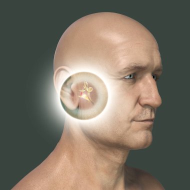 Otitis medyası, orta kulağın bir grup iltihaplı hastalığı, üç boyutlu illüstrasyonlar orta ve iç hava ve orta havada irin birikimine sahip bir erkeği gösteriyor.