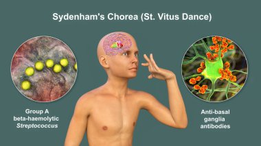 Sydenham 'ın koreası, Streptococcus enfeksiyonundan kaynaklanan otoimmün bir hastalık, beyin bazal gangliyasına zarar veren anti-nöronal antikorların oluşumu istemsiz hareketlere, 3 boyutlu illüstrasyonlara,