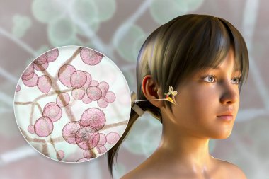 Otitis medyasının bir nedeni olarak Candida mantarları. 3 boyutlu illüstrasyon, bir kızda orta kulakta iltihaplanma ve Candida mayalarının yakın çekim görüntüsünü gösteriyor.