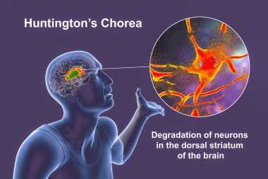 Dorsal striatum, caudate nucleus ve putamen, Huntington hastalığı olan bir insanın beyninde vurgulanmış ve nöronal bozulmaya yakın çekim, kavramsal 3D illüstrasyon