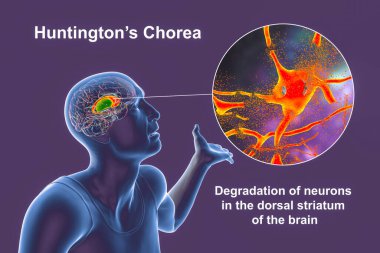 Dorsal striatum, caudate nucleus and putamen, highlighted in the brain of a person with Huntington's disease and close-up view of neuronal degradation, conceptual 3D illustration clipart